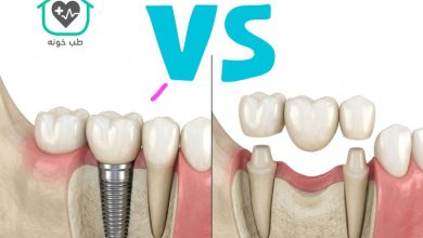 بریج بهتر است یا ایمپلنت